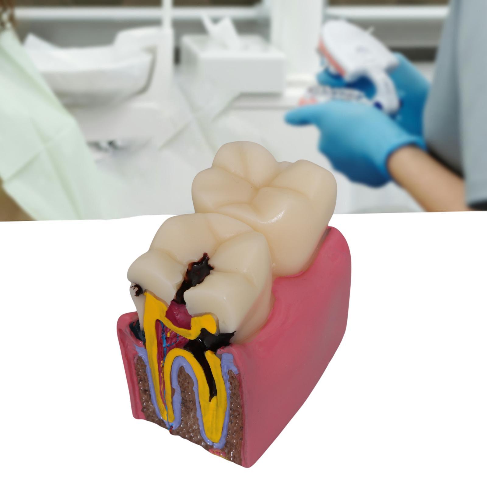 Tooth Decay Model Roots Canal  - Kids Education Classes ulasan dan harga